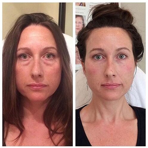 Girl before and after facial rejuvenation with laser