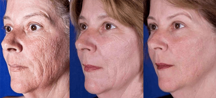 Result after the facial skin rejuvenation procedure with the laser