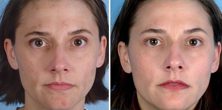 before and after skin rejuvenation with the device