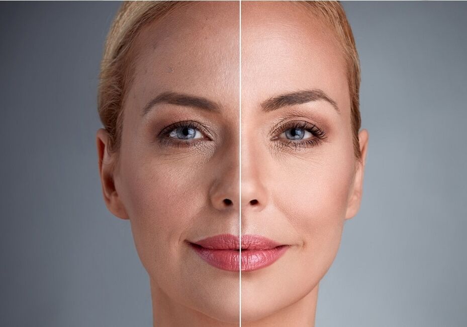 before and after laser facial rejuvenation