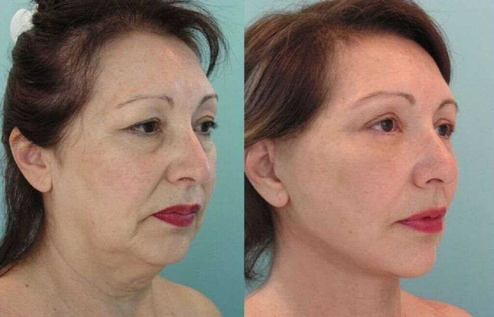 photos before and after skin rejuvenation
